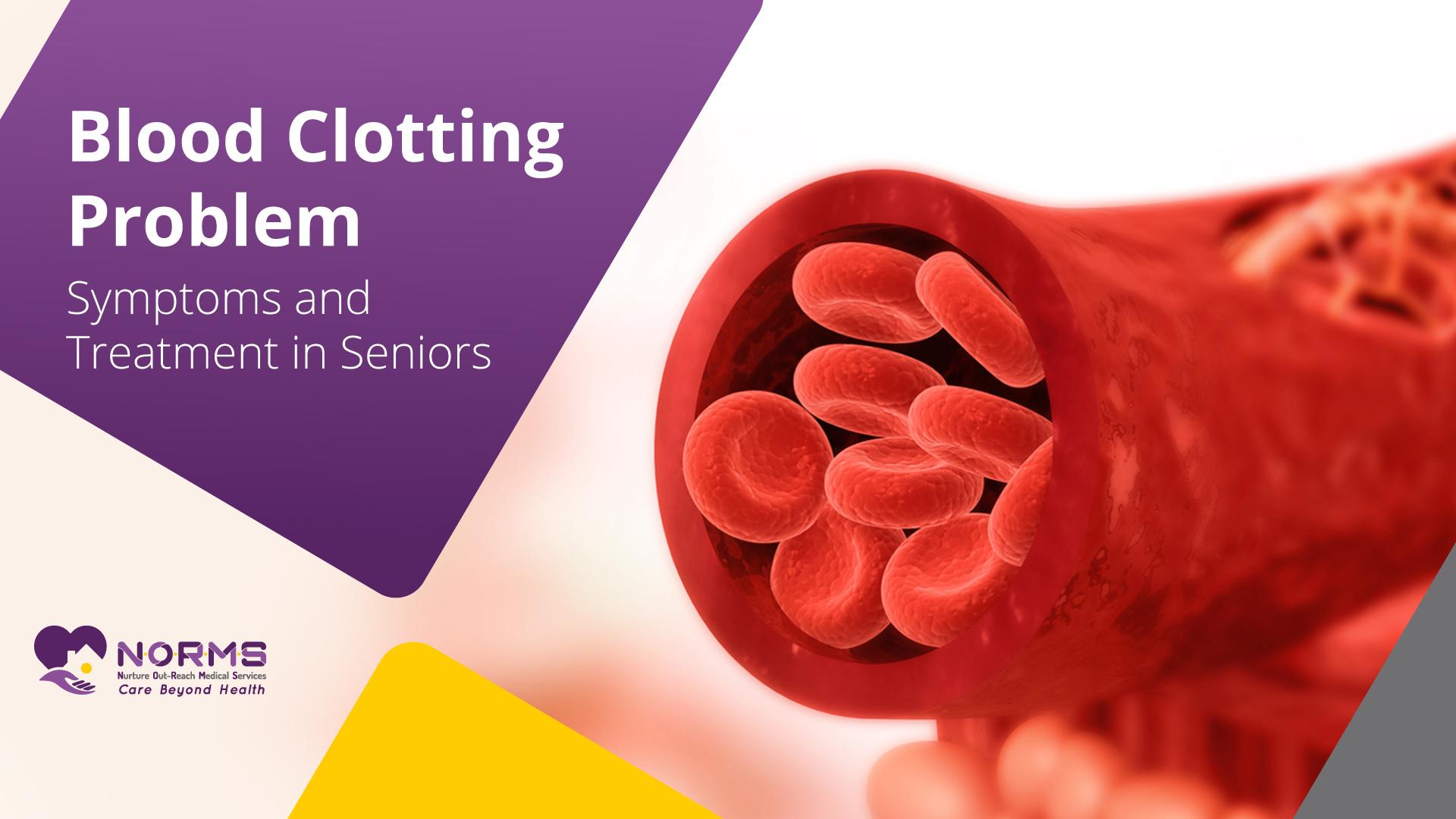 Blood Clotting Problem: Symptoms and Treatment in Seniors