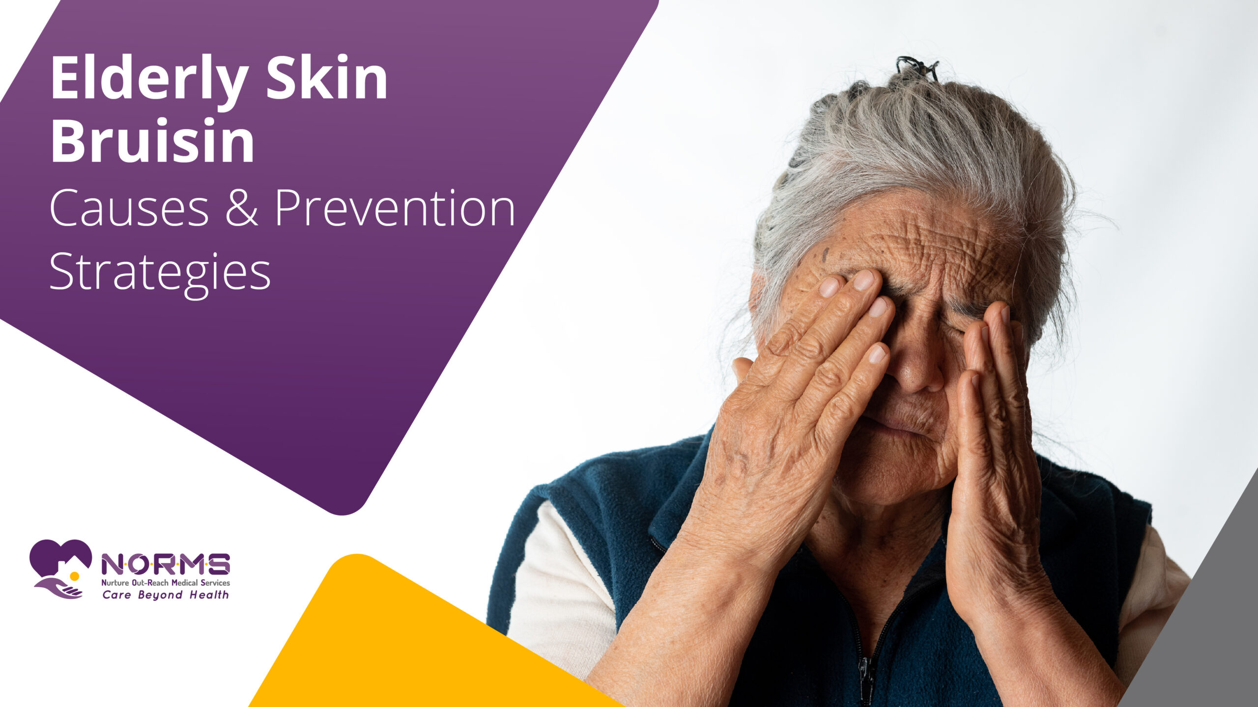 Elderly Skin Bruising: Causes and Prevention Strategies