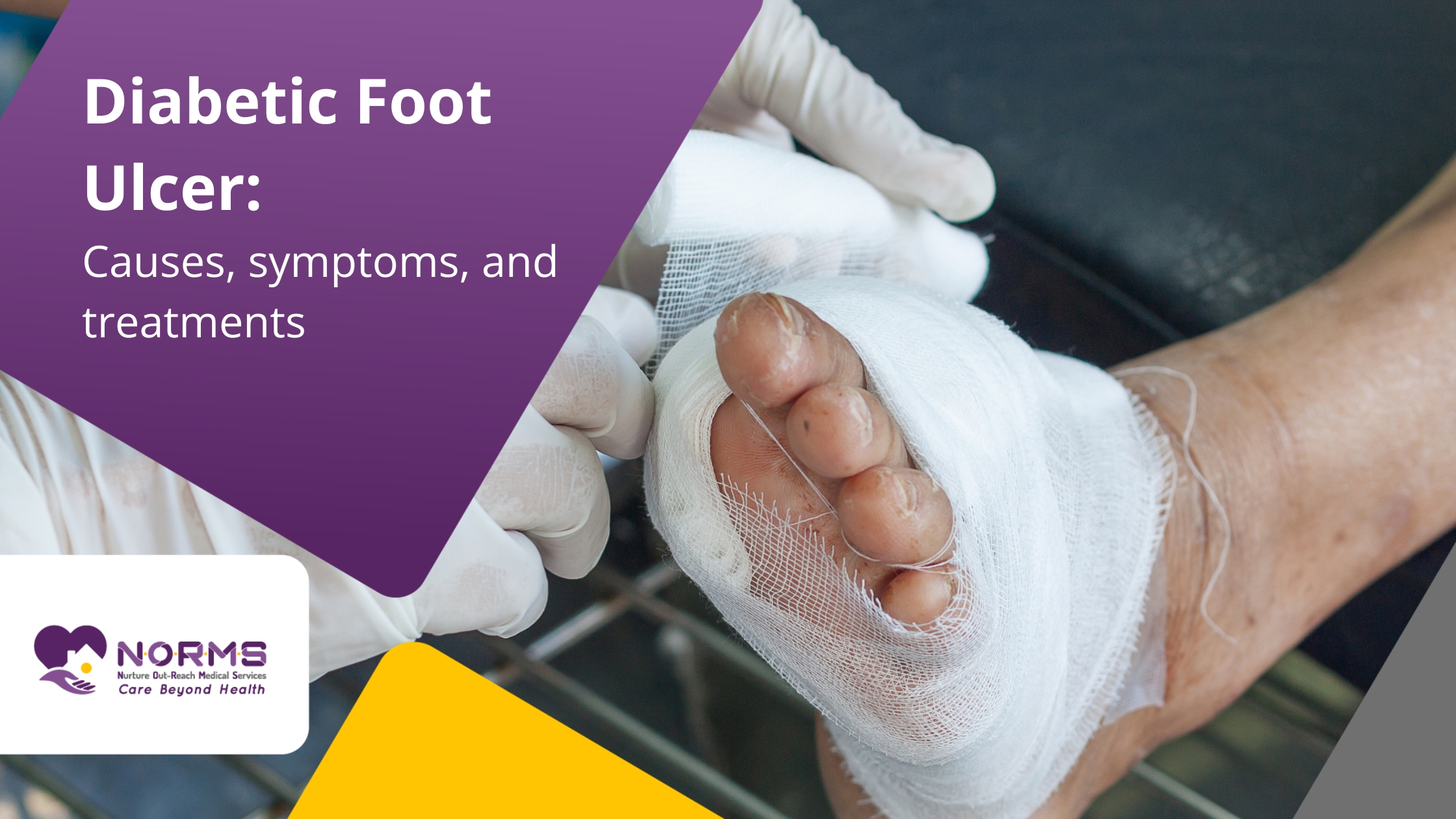 Diabetic Foot Ulcer: Causes, symptoms and treatments